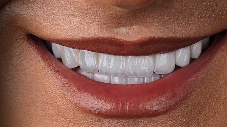 Hollywood Smile result with natural incisal edges