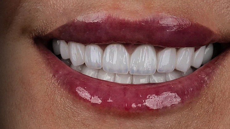 Full smile makeover result, close up