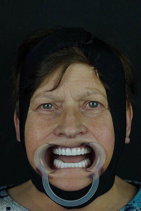 The same patient after the full restoration