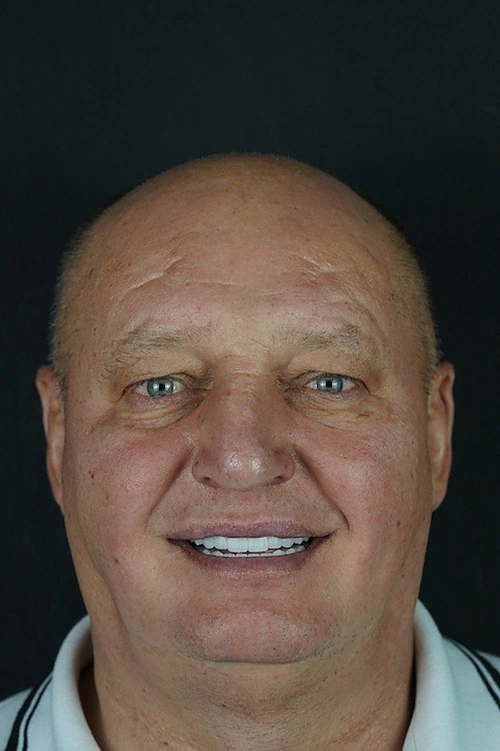 The same patient smiling after the restoration