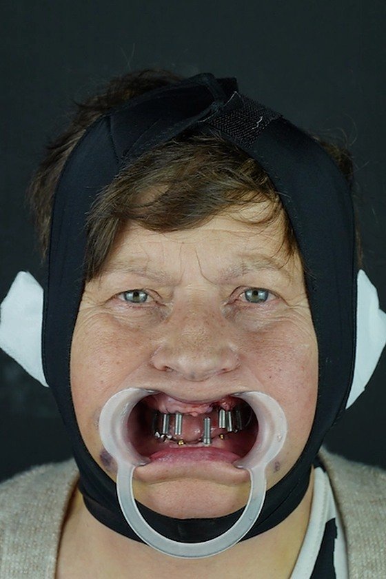 Patient before treatment, implant posts in the upper jaw