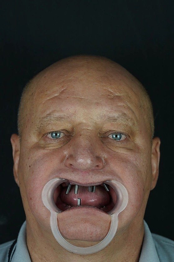 Patient before treatment, edentulous upper jaw with implant posts
